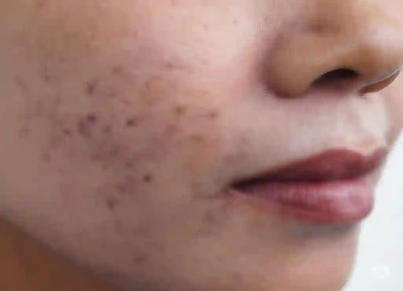 darkspots